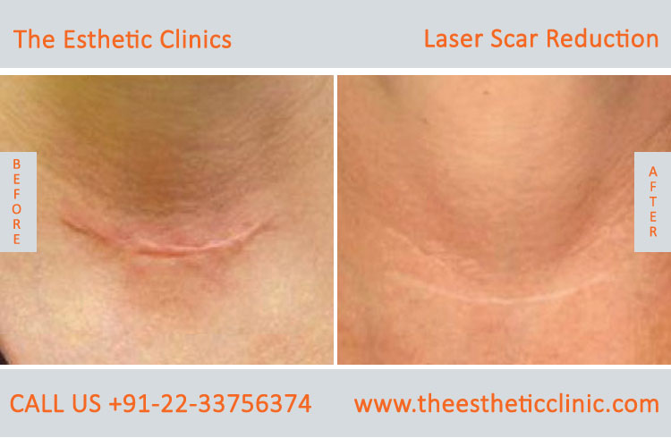 Laser scar reduction removal Treatment before after photos in mumbai india (4)